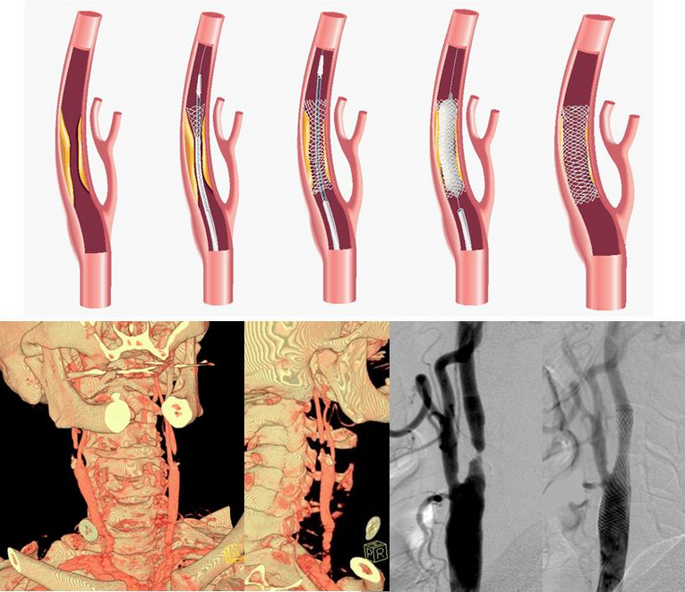 Stent-Implantation bei Einengung der Hirnschlagader