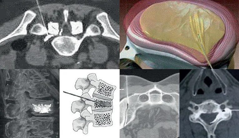 Minimal-invasive Schmerztherapie der Wirbelsäule