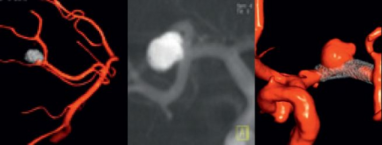 Behandlung von Aneurysmen mit Coiling oder Flow Diverter