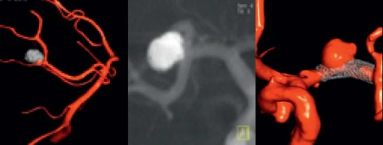 Behandlung von Aneurysmen mit Coiling oder Flow Diverter